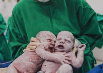 Foto de gêmeas se abraçando logo após parto em SC viraliza na internet
