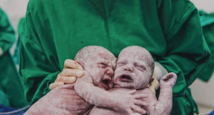 Foto de gêmeas se abraçando logo após parto em SC viraliza na internet