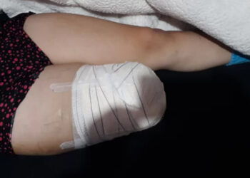 Jovem que perdeu perna em acidente em Jaraguá do Sul busca prótese