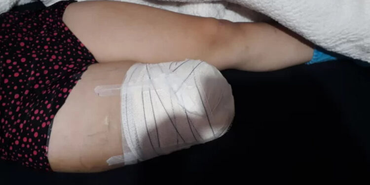 Jovem que perdeu perna em acidente em Jaraguá do Sul busca prótese
