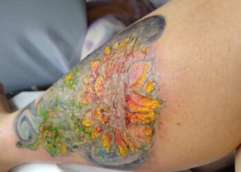 Tatuador usa tinta imprópria e mulher quase perde a perna em Joinville