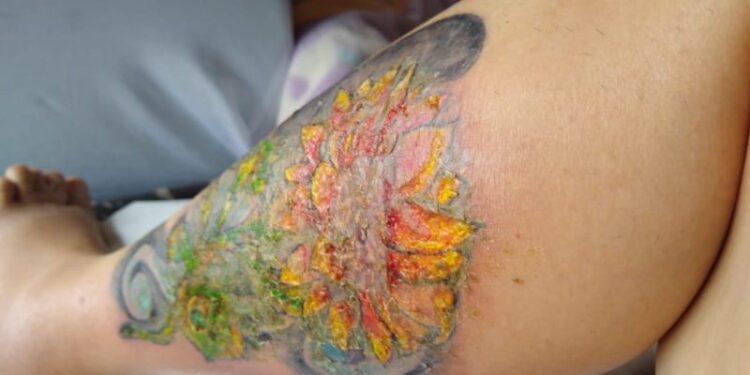 Tatuador usa tinta imprópria e mulher quase perde a perna em Joinville