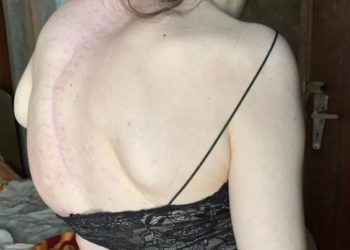 Jaraguaense com escoliose busca ajuda para realizar cirurgia