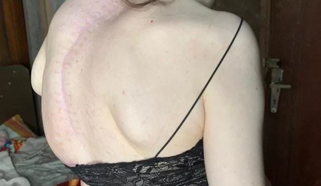 Jaraguaense com escoliose busca ajuda para realizar cirurgia