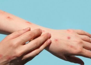 Jaraguá confirma primeiro caso de varíola dos macacos