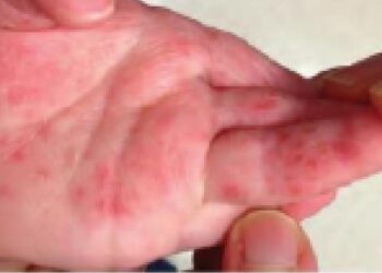 Prefeitura de Jaraguá do Sul monitora casos de mão-pé-boca