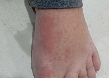 Santa Catarina confirma três casos de ‘Febre do Maruim’