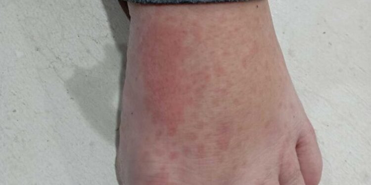 Santa Catarina confirma três casos de ‘Febre do Maruim’