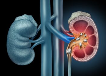 Pedra no rim: ouvintes dizem que receitas caseiras podem ajudar a eliminar cálculos renais
