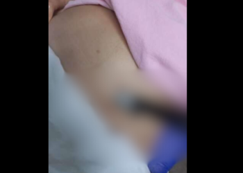 Ex-companheiro esfaqueia mulher e faca quebra dentro do corpo da vítima em Joinville