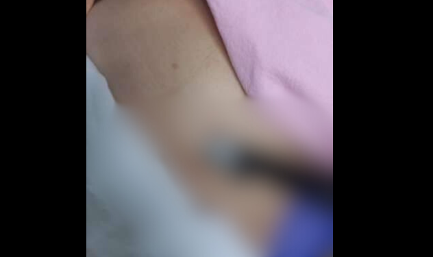 Ex-companheiro esfaqueia mulher e faca quebra dentro do corpo da vítima em Joinville