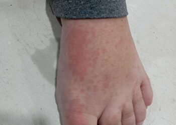 Santa Catarina tem dez casos de febre do maruim