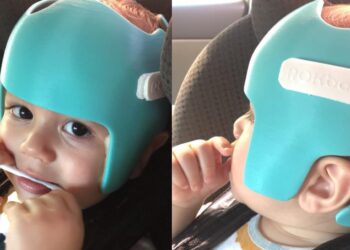 Continua a campanha para ajudar bebê com plagiocefalia em Jaraguá do Sul