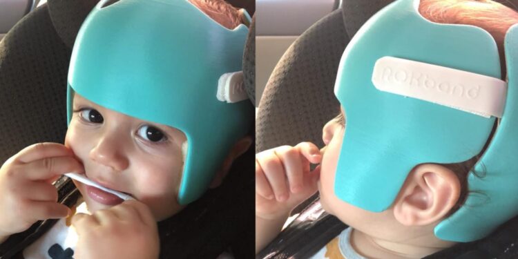 Continua a campanha para ajudar bebê com plagiocefalia em Jaraguá do Sul