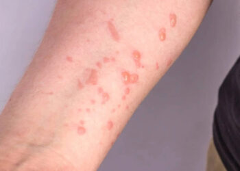 Vacina brasileira contra a mpox está próxima dos testes em humanos