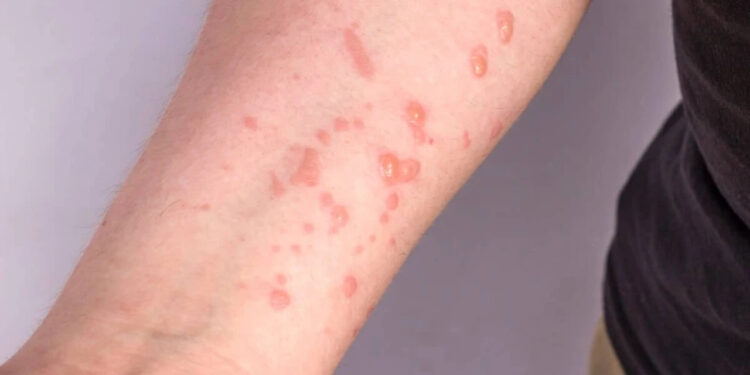 Vacina brasileira contra a mpox está próxima dos testes em humanos