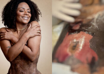 Mulher que ficou com corpo necrosado após cirurgia em SC destaca: “eu sobrevivi”