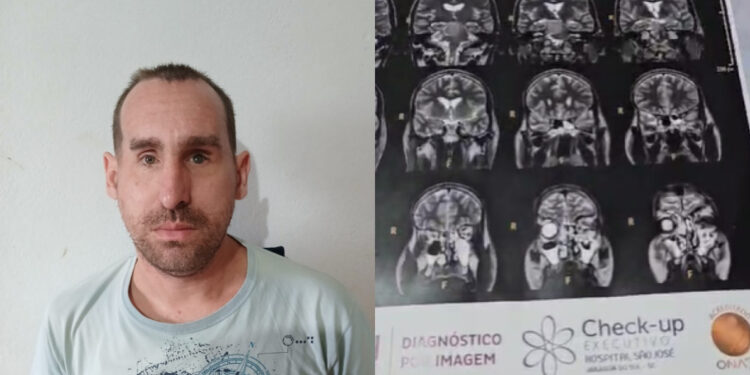 Morador de Jaraguá do Sul é diagnosticado com tumor no cérebro e precisa de ajuda para cirurgia de emergência