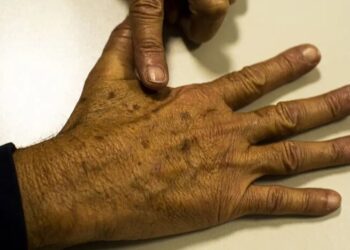 Jaraguá do Sul promove mutirão para rastreamento de câncer de pele