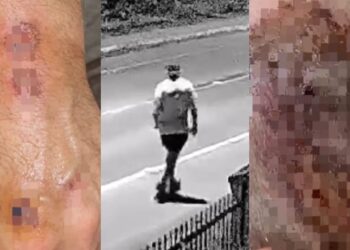 [Vídeo] Senhor é atropelado enquanto praticava exercício em Guaramirim e motorista foge: “Saí para correr e acordei no hospital”