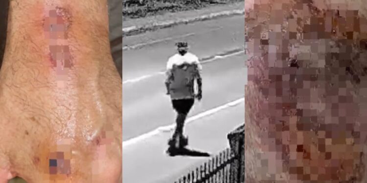 [Vídeo] Senhor é atropelado enquanto praticava exercício em Guaramirim e motorista foge: “Saí para correr e acordei no hospital”