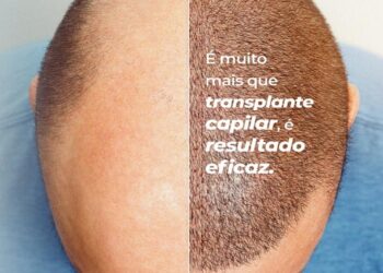 Transplante Capilar: A Solução Definitiva para Recuperar Seus Fios com Naturalidade