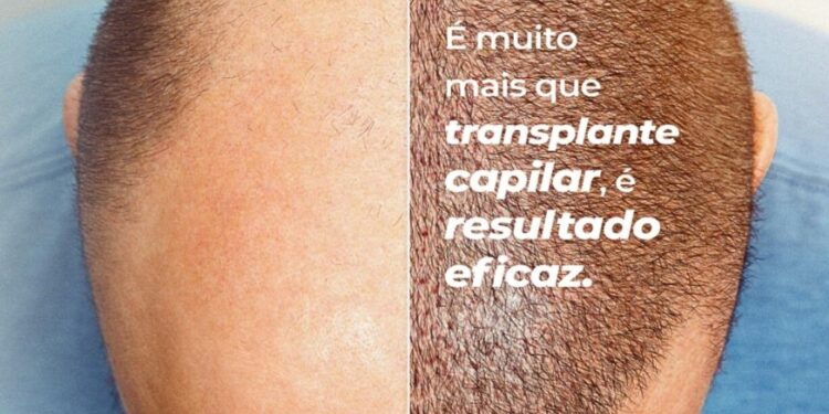 Transplante Capilar: A Solução Definitiva para Recuperar Seus Fios com Naturalidade