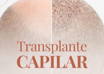 Transplante Capilar: autoestima e transformação em cada fio