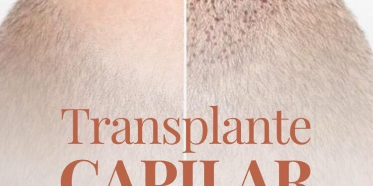 Transplante Capilar: autoestima e transformação em cada fio