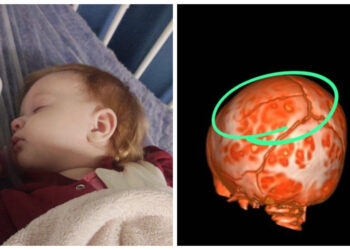 Bebê de cinco meses cai em creche e sofre fratura no crânio em Corupá; Prefeitura promete punição