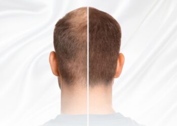 Como é feito o transplante capilar e quais são as técnicas usadas?