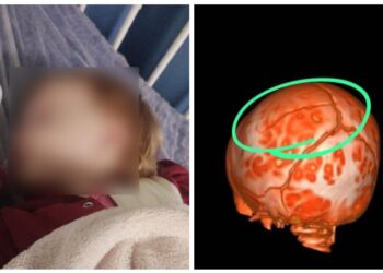 Ministério Público de SC apura possível negligência na queda de bebê em creche de Corupá