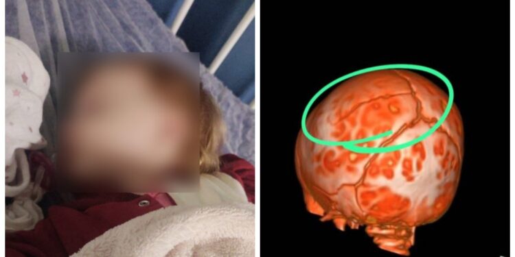 Ministério Público de SC apura possível negligência na queda de bebê em creche de Corupá