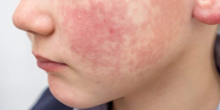 “Síndrome da bochecha esbofeteada”: Massaranduba em alerta para casos de eritema infecciosa em crianças