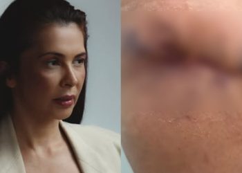 Clínica de Jaraguá do Sul é interditada após modelo sofrer necrose na pele