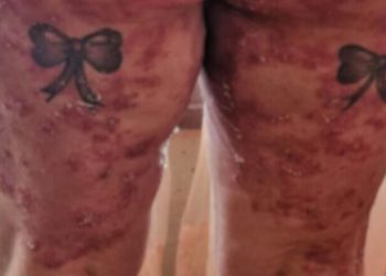 “Queima como fogo”: Moradora de Jaraguá luta contra doença rara e busca apoio para cuidar da família